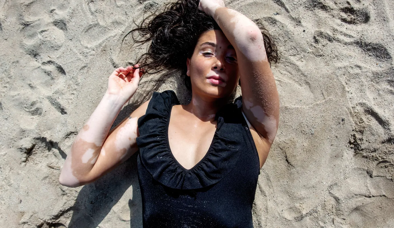 Vitiligo