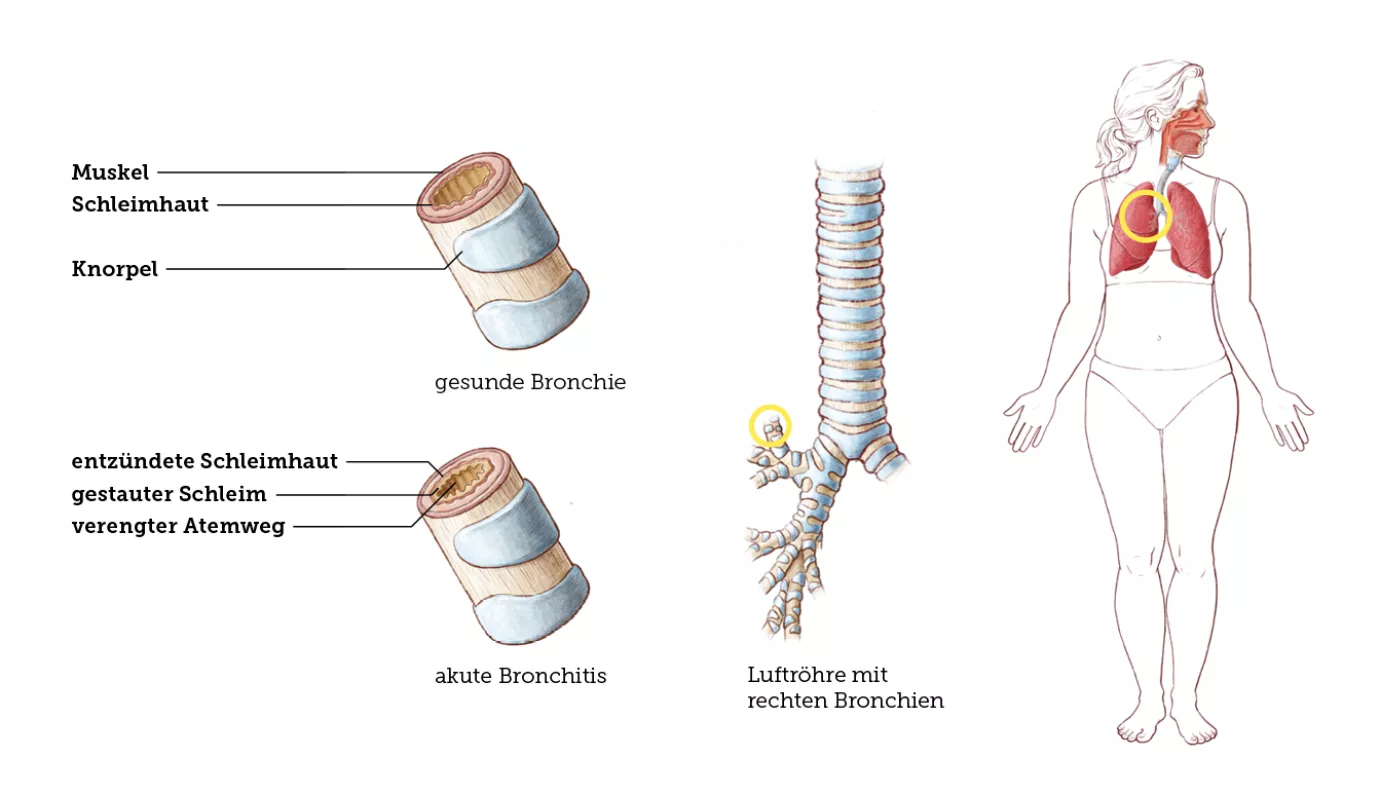 Bronchitis