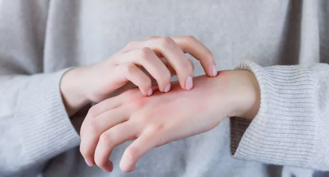 Eczema cronico delle mani